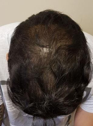 Why Am I Losing Hair? Causes You Should Rule Out First