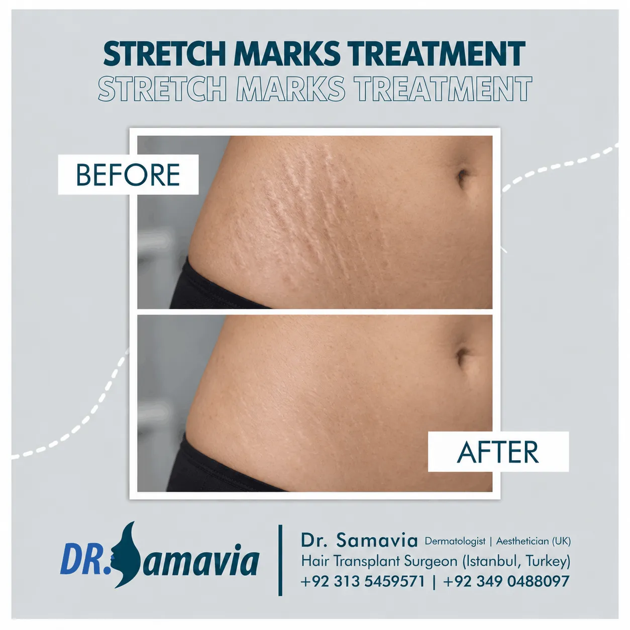 Stretch Marks Treatment