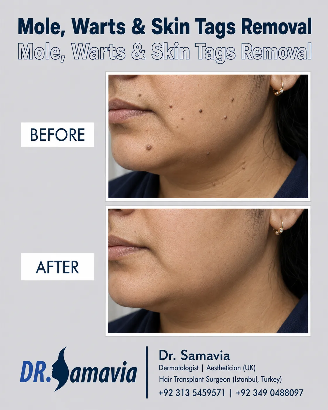 Mole, Warts & Skin Tags Removal