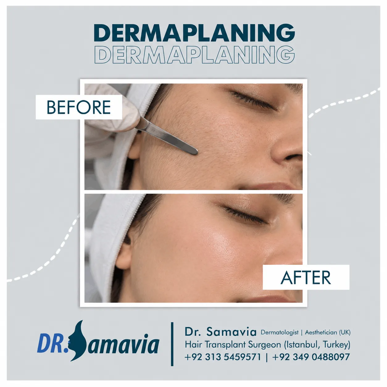 Dermaplaning